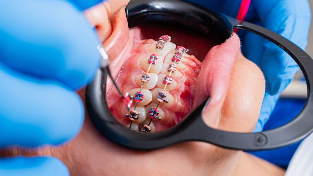 Dentysta kontroluje aparat stały na zębach pacjenta Dentysta kontroluje aparat stały na zębach pacjenta